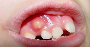أعراض وشكل أكياس الأسنان والتورم